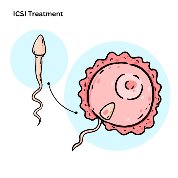 ICSI treatment